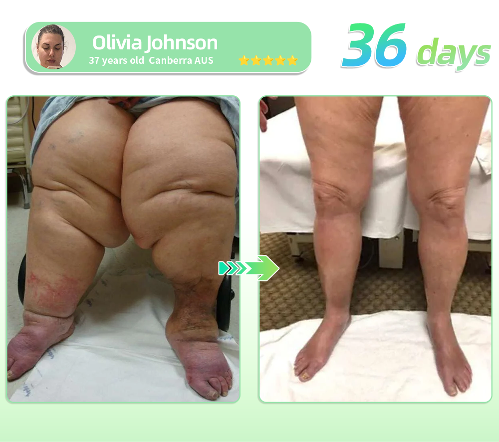Persistence = Results! 30% HHVB discount for a limited time. Many users choose to purchase 6 boxes at a time (60 DAYS usage) as this not only stabilizes the results, but also allows them to take advantage of the awesome combo offer! 👍